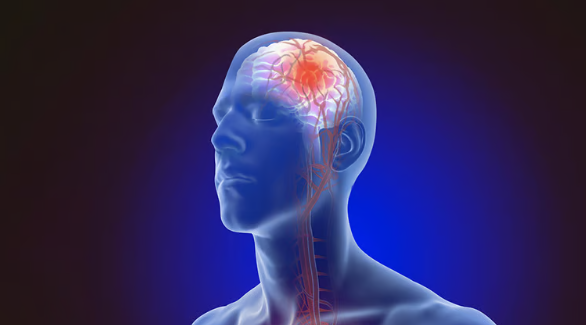 Stroke treatment