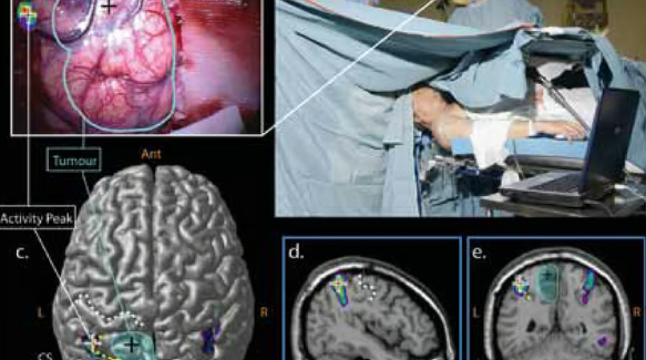 Neurological Disorders